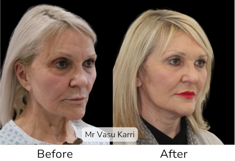 Facelift Patient 15 View 2